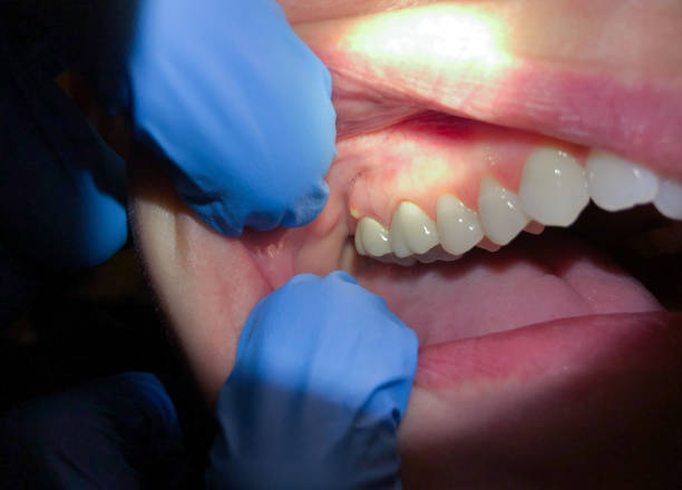 Best Emergency Dental Extractions in Bee Ridge, FL