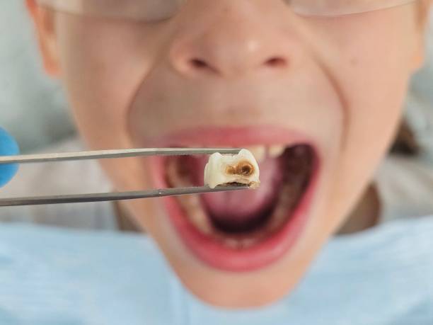 Best Emergency Dentist for Lost Fillings or Crowns in Bee Ridge, FL
